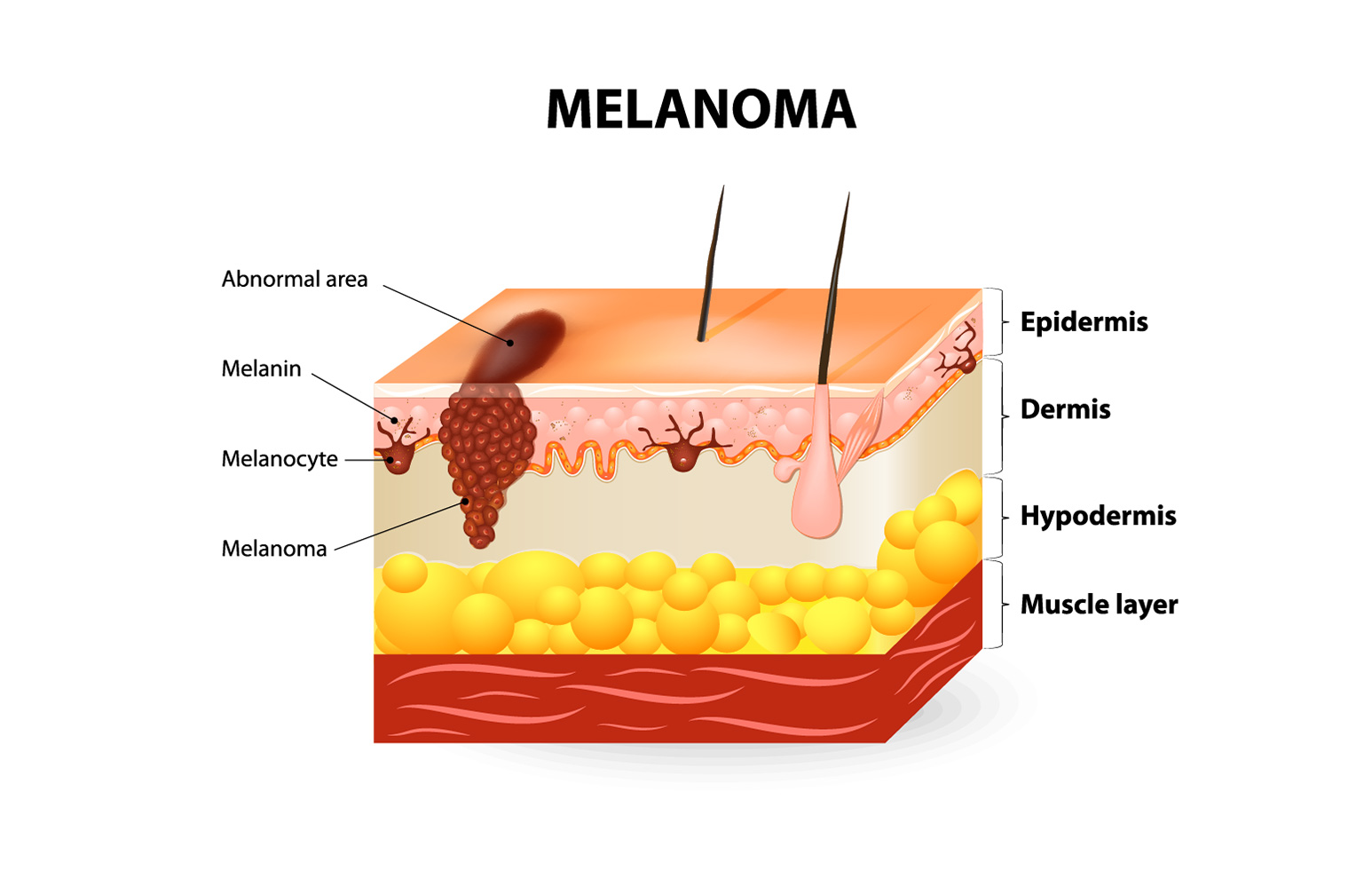 Malignant Melanoma