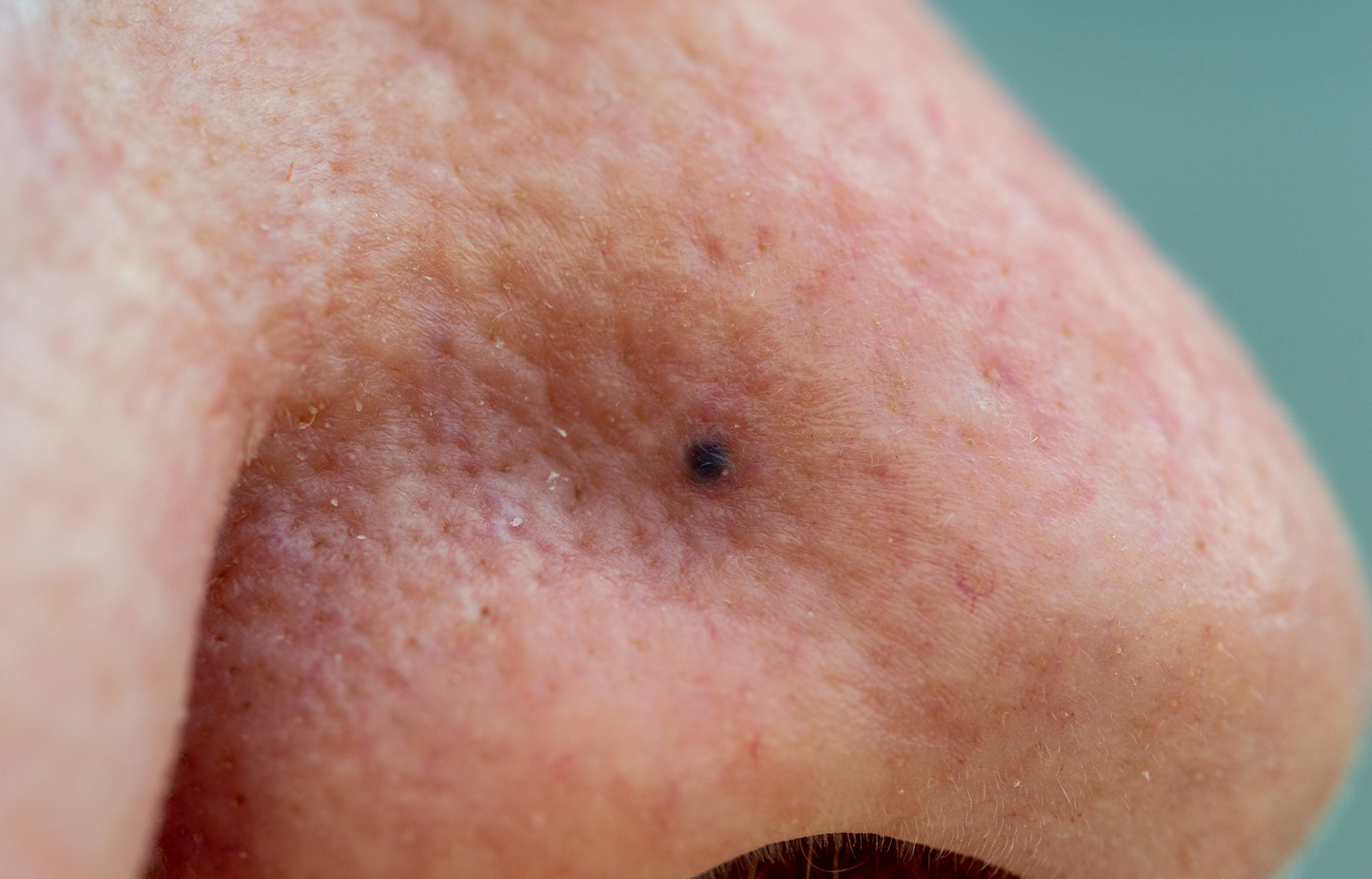 Malignant Melanoma