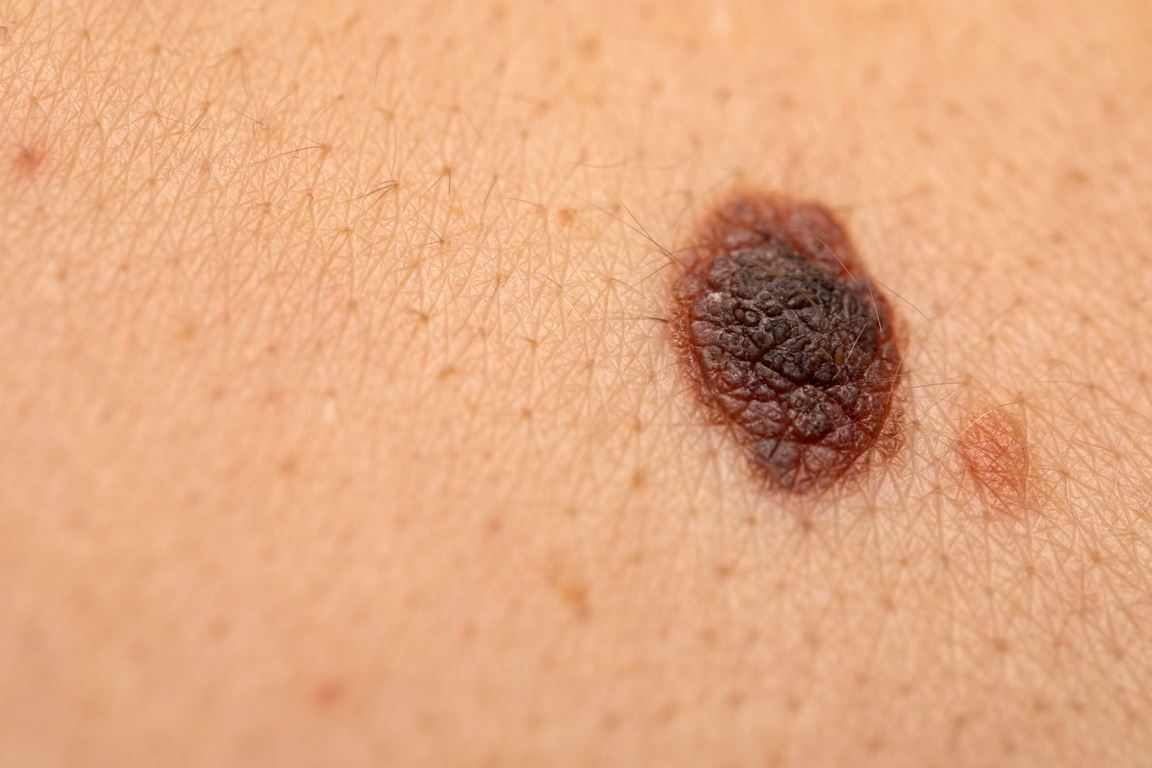 Malignant Melanoma