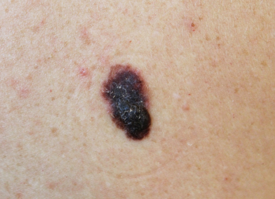 Malignant Melanoma