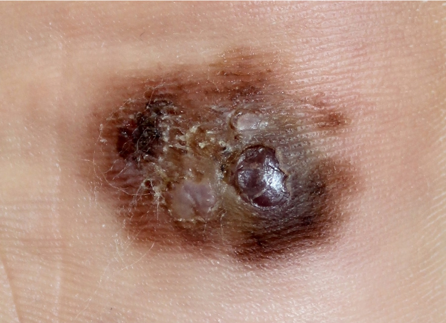 Malignant Melanoma