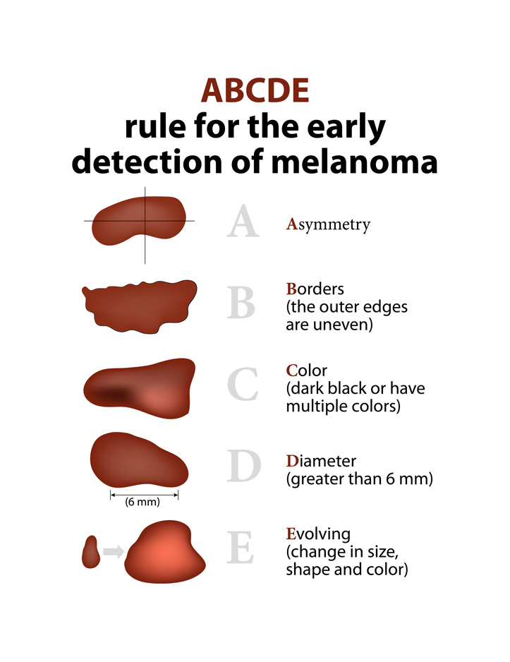 Malignant Melanoma