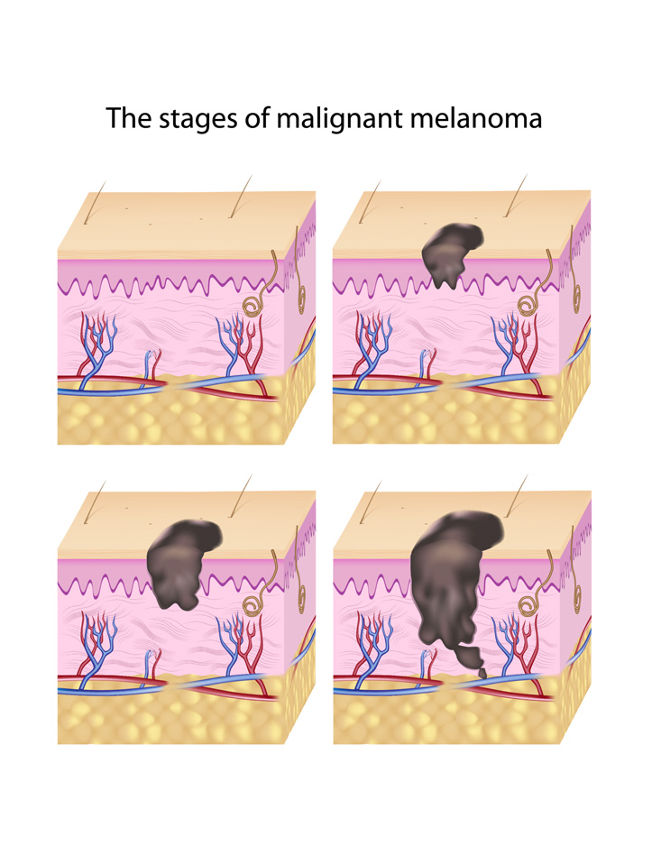 Malignant Melanoma